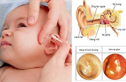 Vì Sao Trẻ Nhỏ Dễ Bị Viêm Tai Giữa? Bố Mẹ Hiểu Đúng Và Phòng Ngừa Hiệu Quả